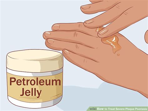 How To Treat Severe Plaque Psoriasis 9 Steps With Pictures
