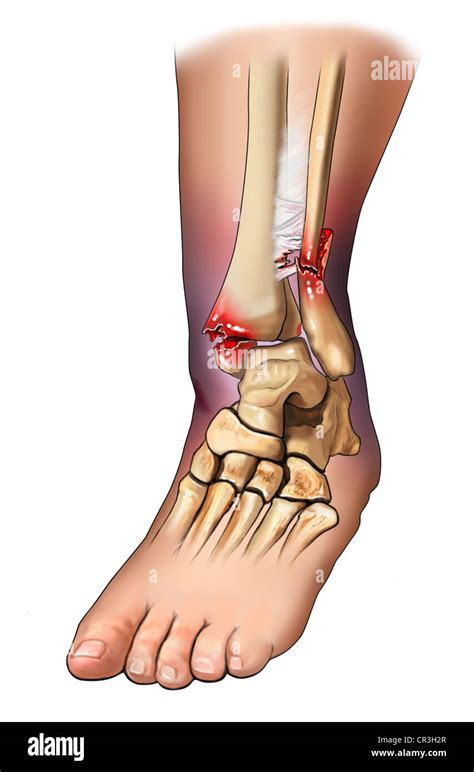 Bimalleolar Fracture Hi Res Stock Photography And Images Alamy