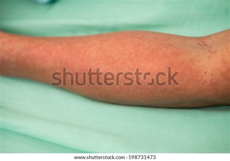 Skin Rash On Right Arm