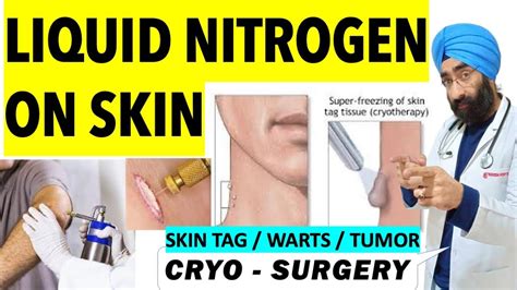 Cryotherapy Super Freezing Skin Tags Warts Or Tumor With Liquid