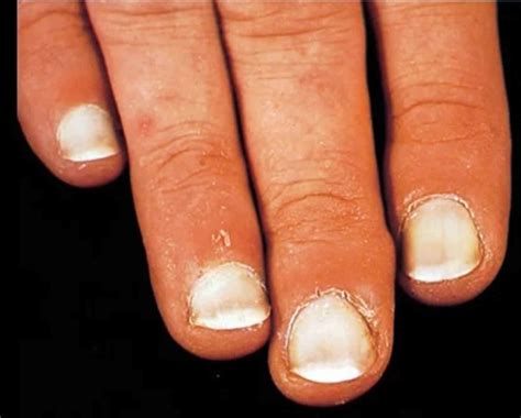 White Spots On Nails Leukonychia Causes Treatment And