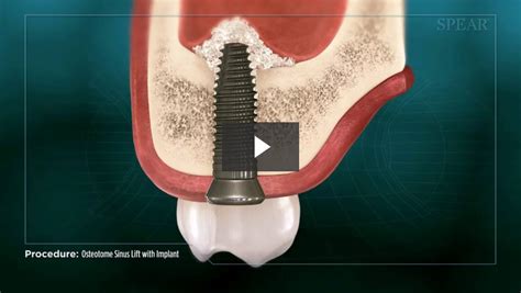 Osteotome Sinus Lift With Implant Placement Cosmetic Dentistry