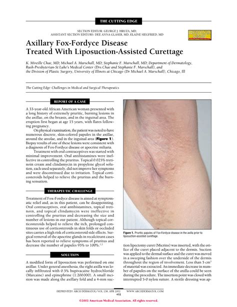 Axillary Fox Fordyce Disease Treated With Liposuction Assisted