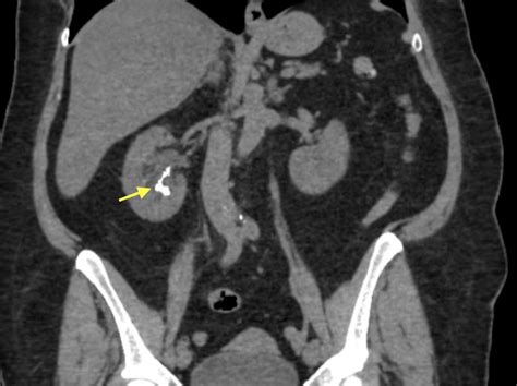 Retained Calcified Guidewire In The Kidney Mimicking A Renal Stone
