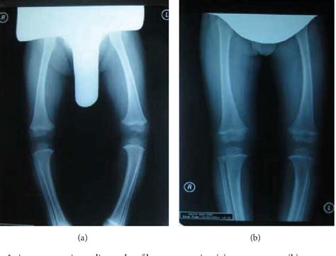 Figure 5 From Orthosis Effects On The Gait Of A Child With Infantile