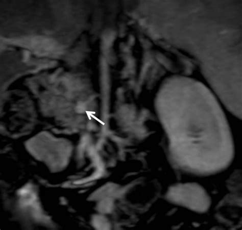 Volume Rendered Ct Demonstrating The Small Intrapancreatic