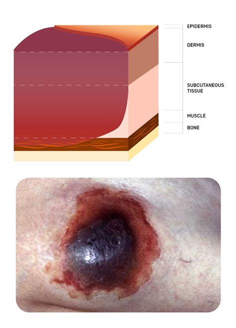 Wound Types Pressure Injuries And Ulcerations