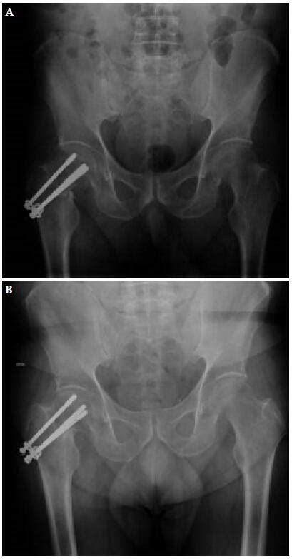 Shortening And Varus Collapse Of Femoral Neck Fractures In Young Patients