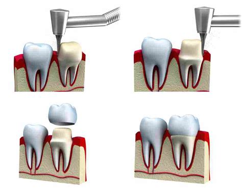 Diferencias de las carillas y las coronas dentales cuándo se indican Estudi Dental Barcelona