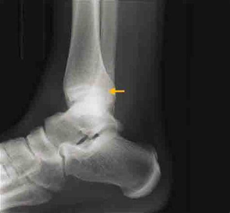 Posterior Distal Tibial Fracture In A Military Trainee Journal Of