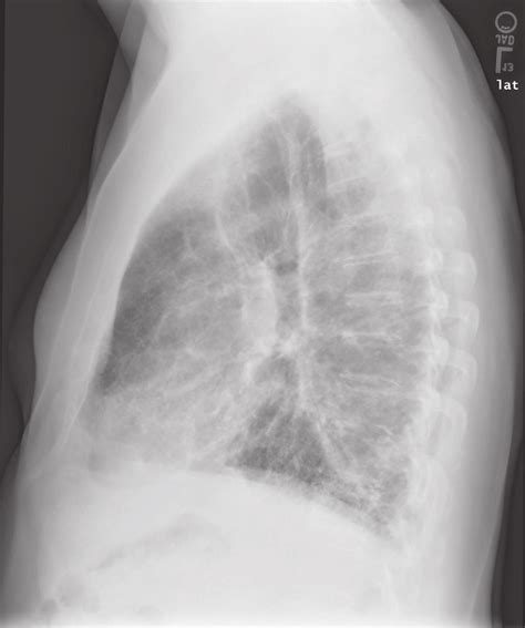 Lateral Chest Radiograph From A Patient With Combined Pulmonary