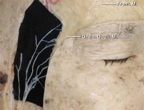Figure The Locations Of The Frontalis Branches Of The Facial Nerve