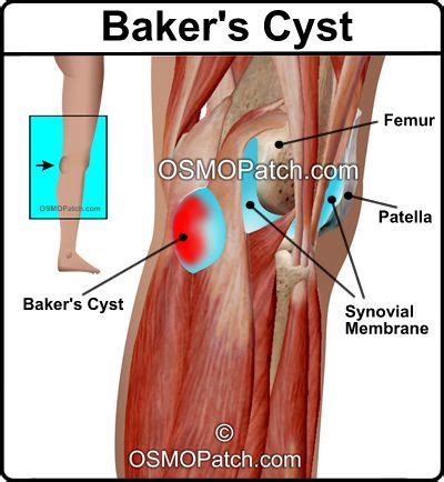 Baker S Cyst