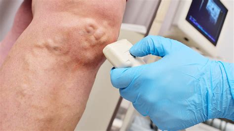 Varicose Veins Causes Symptoms And Treatments