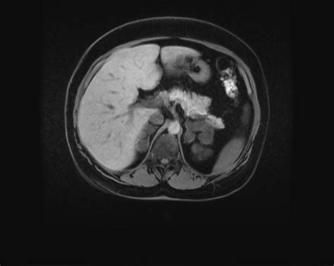 Macronodular Adrenal Hyperplasia Image
