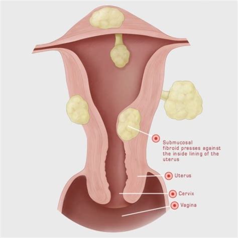 Fibroids And Uterine Fibroid Embolization Fibroid Institute Dallas