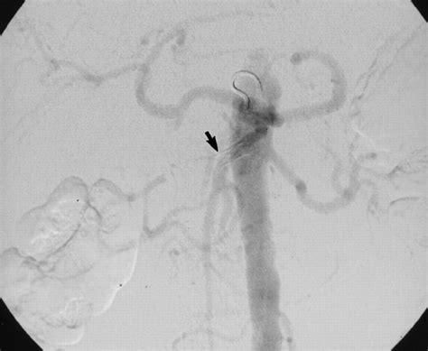 Nonsurgical Treatment Of Acute Iatrogenic Renal Artery Injuries