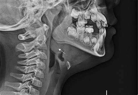 Lingual Tonsillitis An Under‐recognised Manifestation Of Infectious