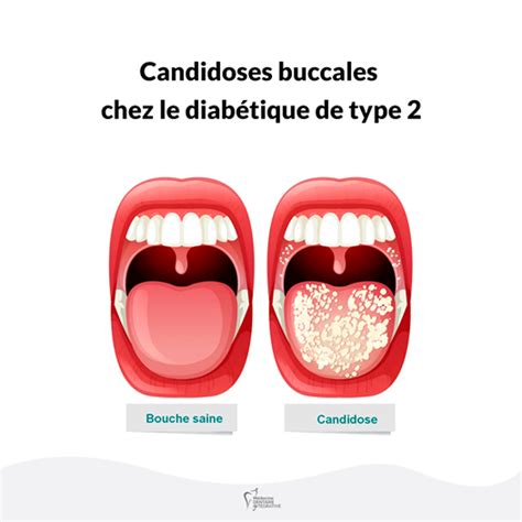 P133 Candidoses Buccales Chez Le Diabétique De Type 2 Orthodiet