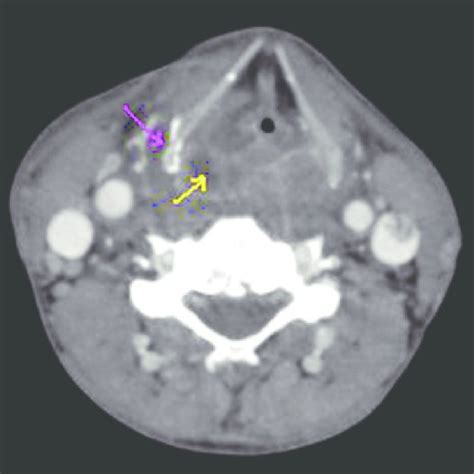 Axial Contrast‑enhanced Computed Tomography At The Level Of Thyroid
