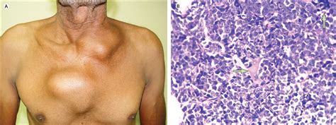 Multiple Chest Wall Swellings In Adult Burkitts Lymphoma The Lancet