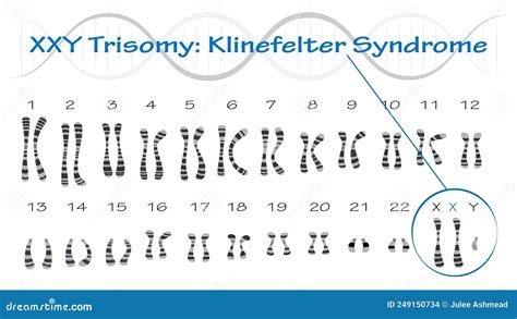 Klinefelter Syndrom Karyotypvektordiagramm Xxy Trisomie Vektor
