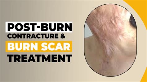 How Do You Treat Burn Scars From Contractures Surgical Treatment Of