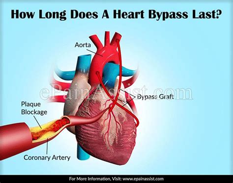 How Long Does The Lima Heart Bypass Last Bypass Coronary Arteries