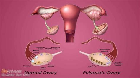 How To Permanently Cure Polycystic Ovary Syndrome Pcos Youtube