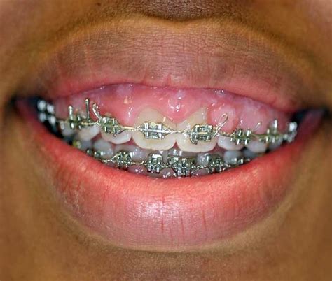 Orthodontics Your Braces Could Be Causing Gum Problems Directorio Odontológico