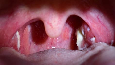 Pharyngeal Tonsil