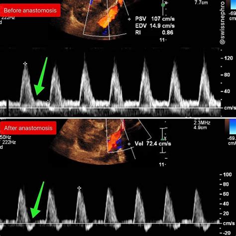 Doppler Waveform Of The Iliac Artery Before And After Transplant Renal