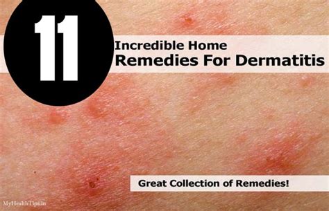 Home Remedies For Dermatitis Dorothee Padraig South West Skin Health Care