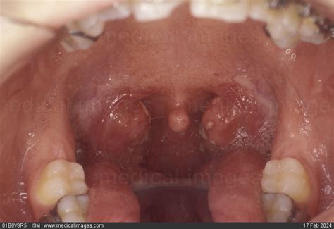 Stock Image Erythematous Reddened And Pultaceous Pulpy Tonsillitis An
