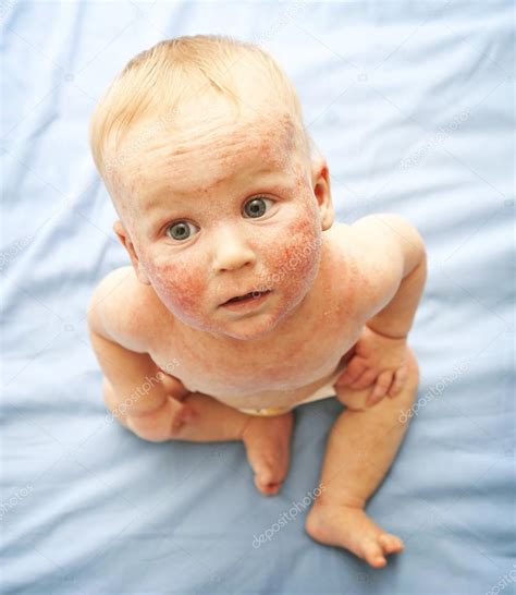 Little Baby With Dermatitis On Face — Stock Photo © Olegkalina 98310188