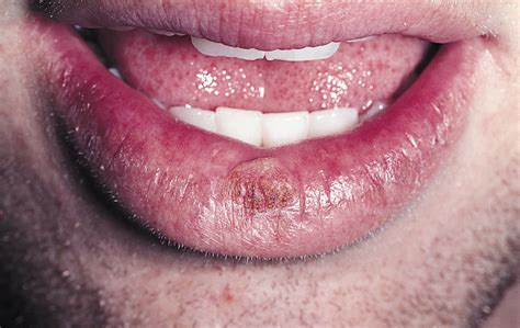 Lesion On Lower Lip