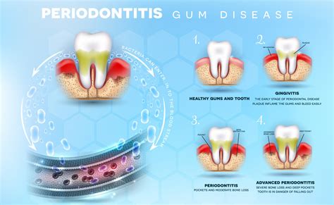 Periodontal Disease Vs Gingivitis School Of Dentistry