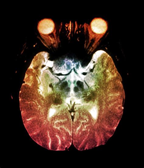 Parkinsons Disease Brain Photograph By Zephyrscience Photo Library