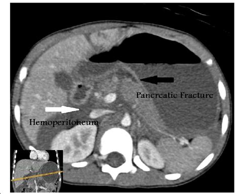 Intravenous Contrast Enhanced Computed Tomography Scan Shows Vertical