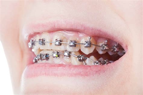 Dental Steel Brackets On Teeth Close Up Mary Cay Koen