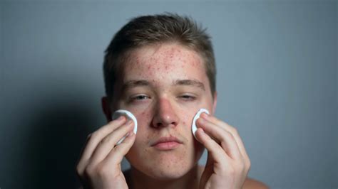 Teenage Boy With Problem Of Acne During Stock Footage Sbv 324456150