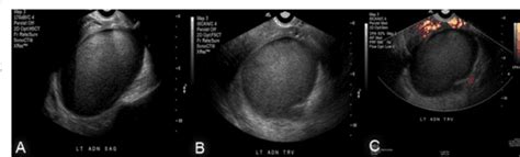 Figure 1 From Sonographic Features Of Tubo Ovarian Abscess Mimicking An