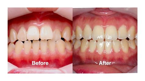 ฟันหน้ามีลักษณะ ฟันล่างคร่อมฟันบน จัดการได้ด้วยจัดฟันใส Bfc Dental
