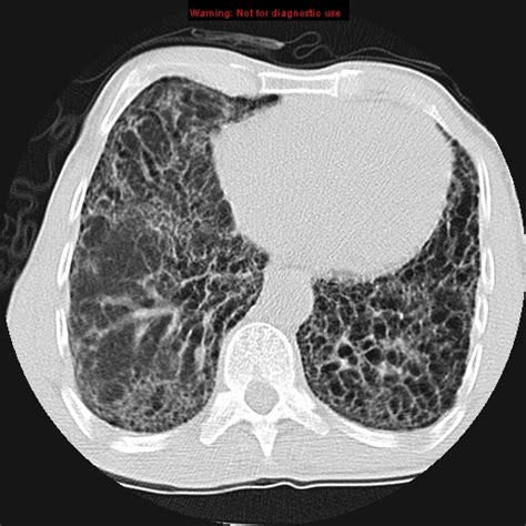 Usual Interstitial Pneumonia Uip Image