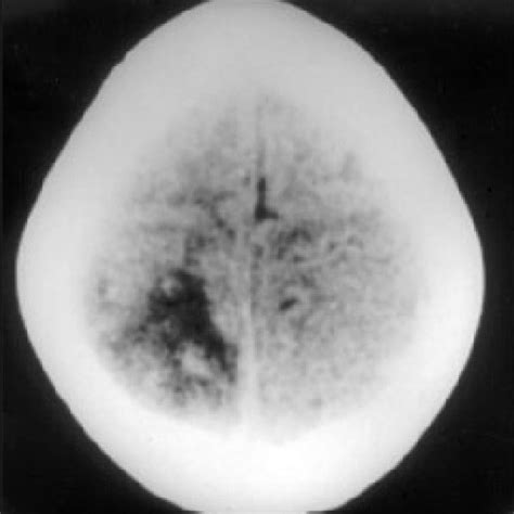 Plain Ct Scan Showing A Large Hypodensity In The Right Parietal Lobe