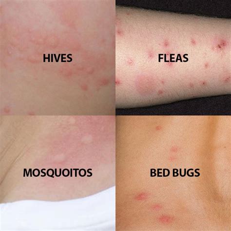 Chigger Bites Vs Bed Bug Bitesidentify Bug Bite Diffe