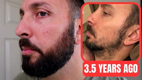 Minoxidil Beard Journey 35 Years Later How To Grow A Real Beard