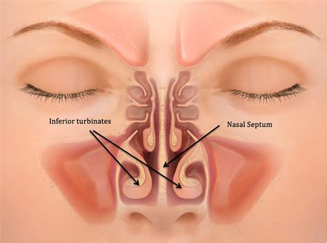 What Is Nasal Septum Perforation New Health Advisor