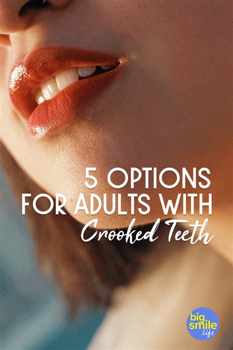 How to fix teeth without braces? Options for adults with crooked teeth. It's never too late ...