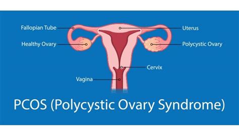 Polycystic Ovary Syndrome Pcos Symptoms And Causes